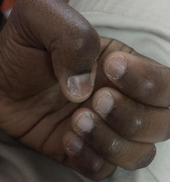 i have a brittle nails and when i grow nails .. its too weak and doesn